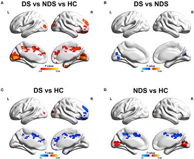 Altered Functional Connectivity of the Nucleus Accumbens Network Between Deficit and Non-deficit Schizophrenia